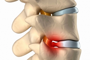 Лечение межпозвонковых грыж, протрузий межпозвонковых дисков, остеохондроза