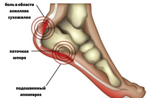 Лечение пяточной шпоры (плантарного фасциита)