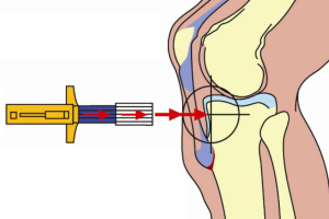 Внутрикостная терапия суставов